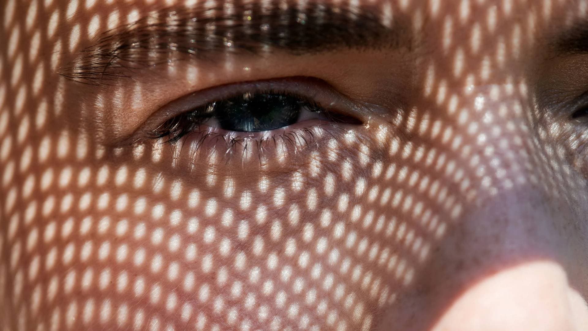 Fotokeratit Gözde Güneş Yanığı