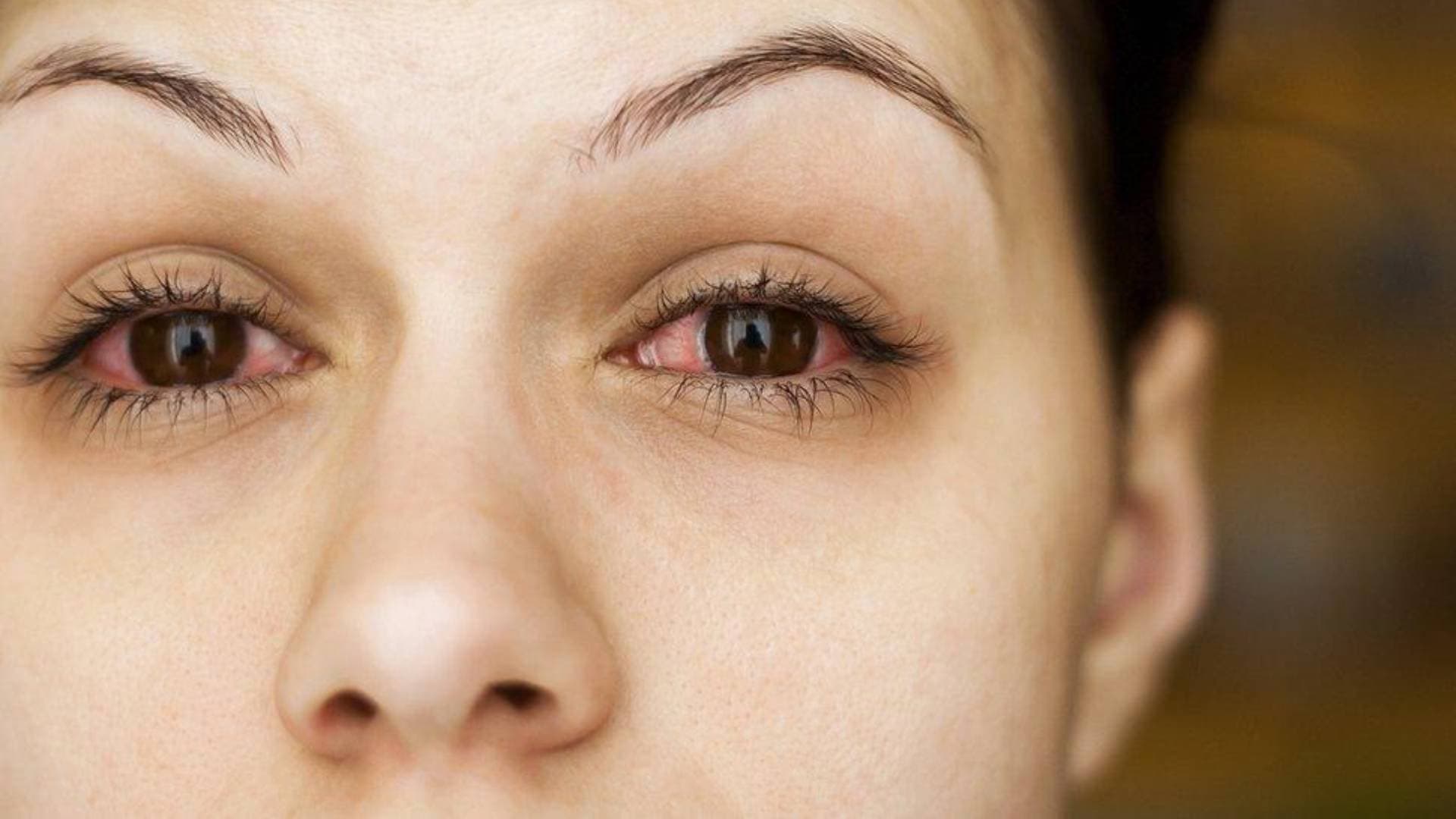 Korona Virüs ve Kontakt Lens Kullanımı