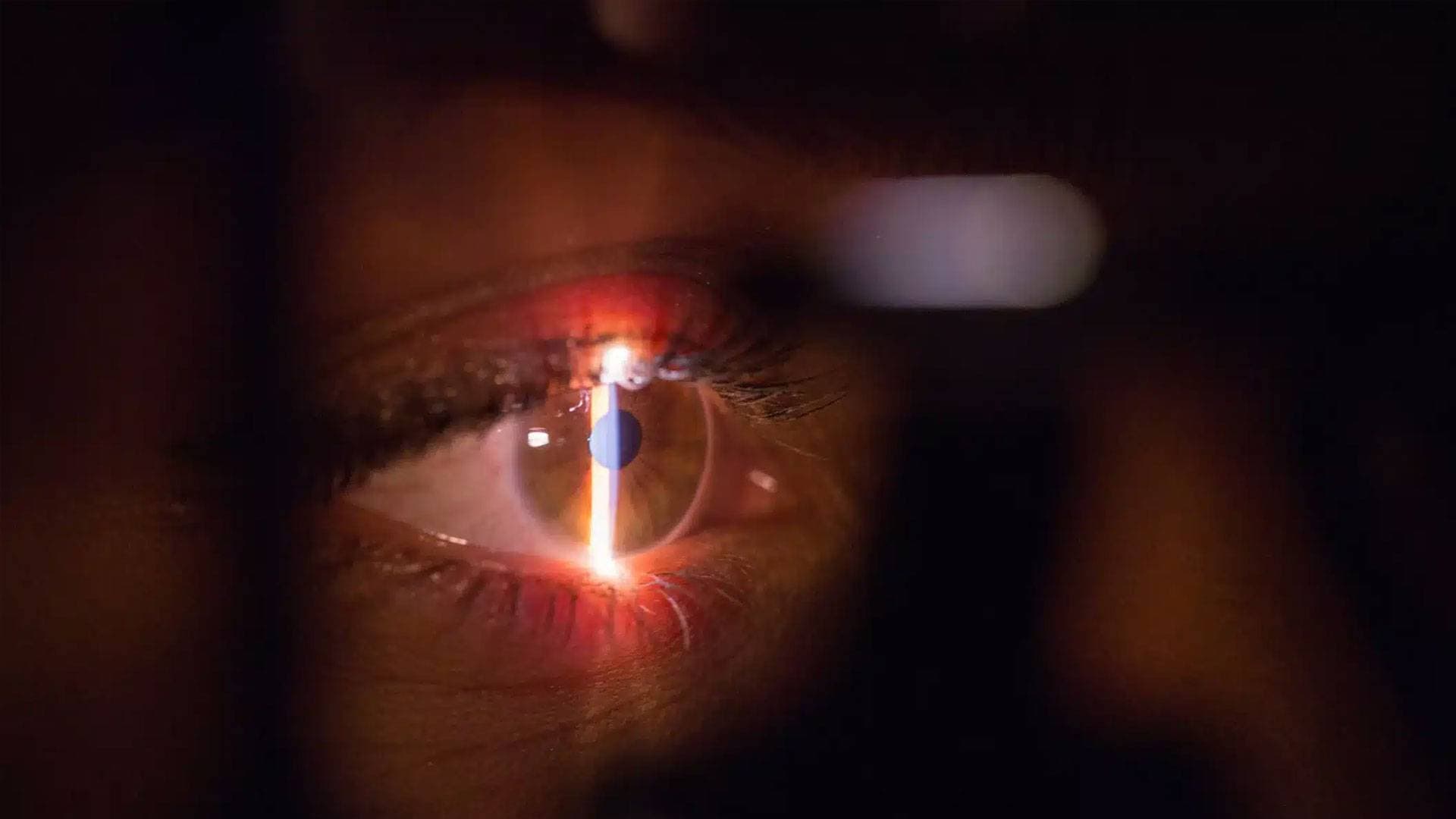 PRK'nın Lasik'ten Farkı Nedir?