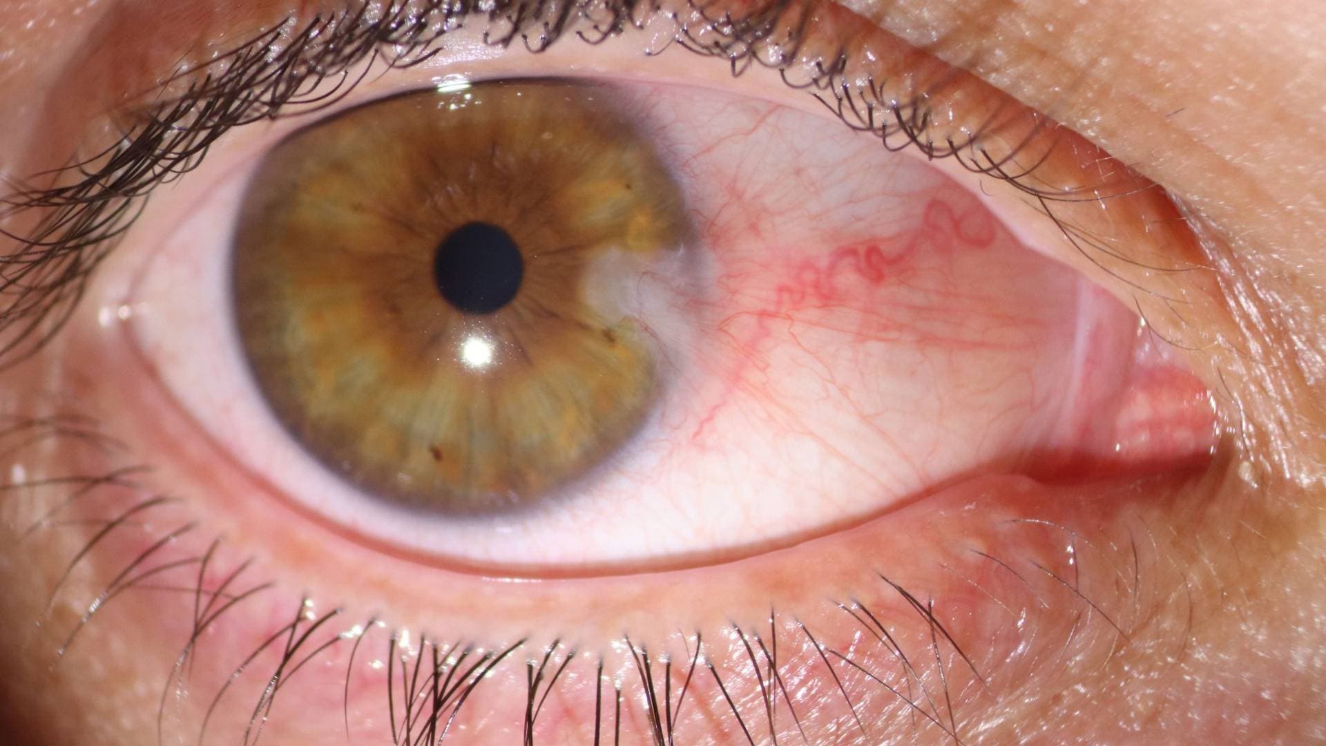 Pterjium (Gözde Et Büyümesi) Tedavi Seçenekleri