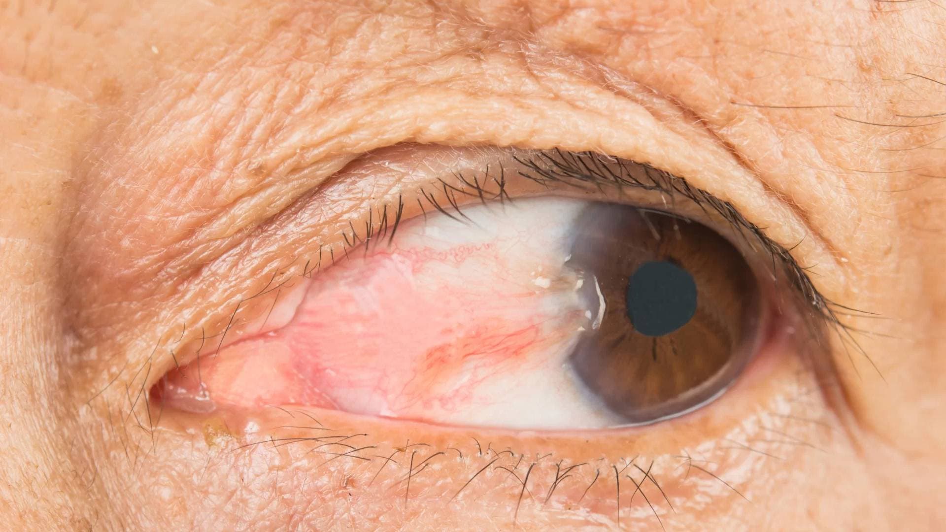 Pterjium Tedavisi