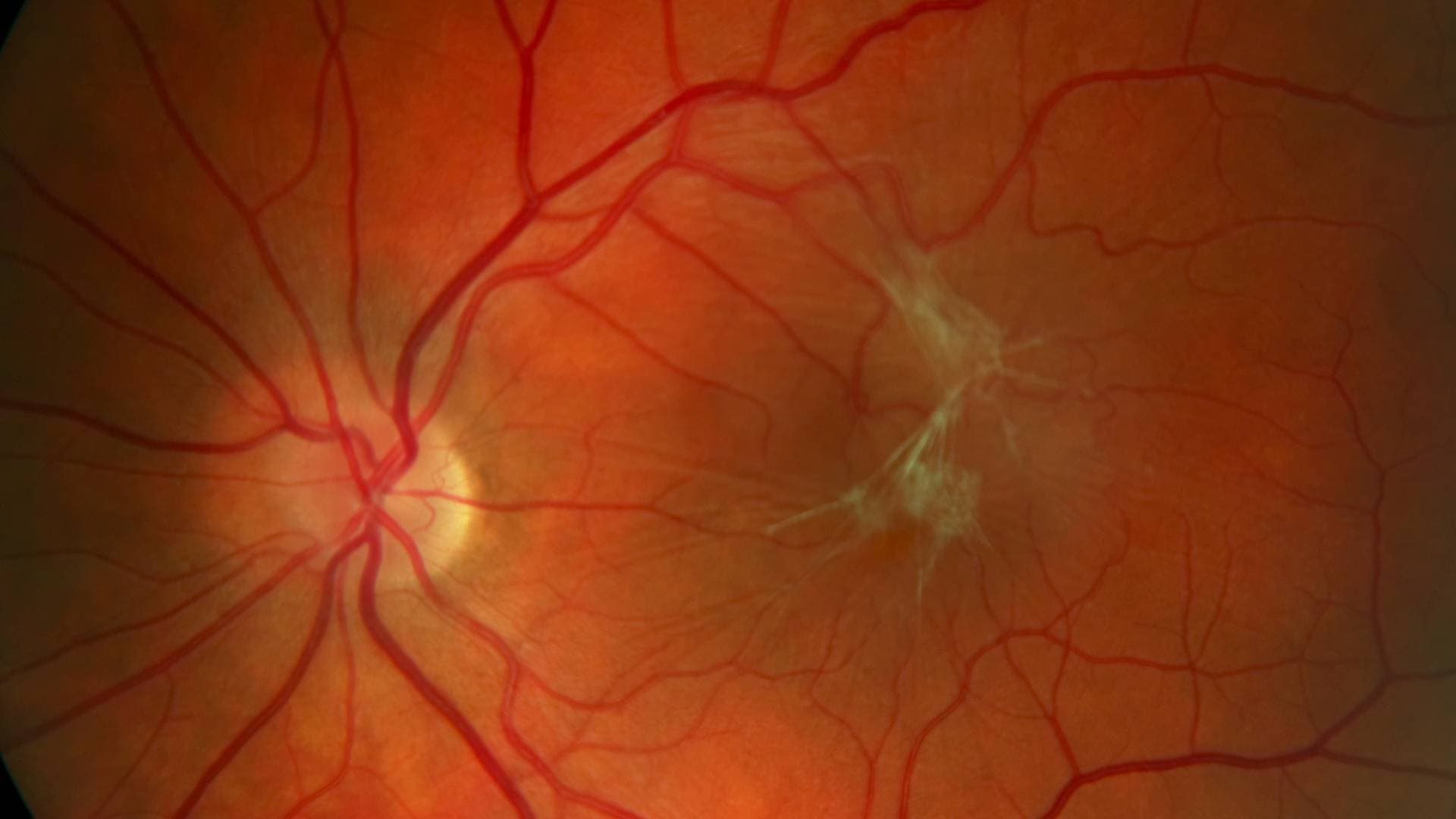 Retina Damar Tıkanıklıkları, Belirtiler, Risk Faktörleri ve Tedavi