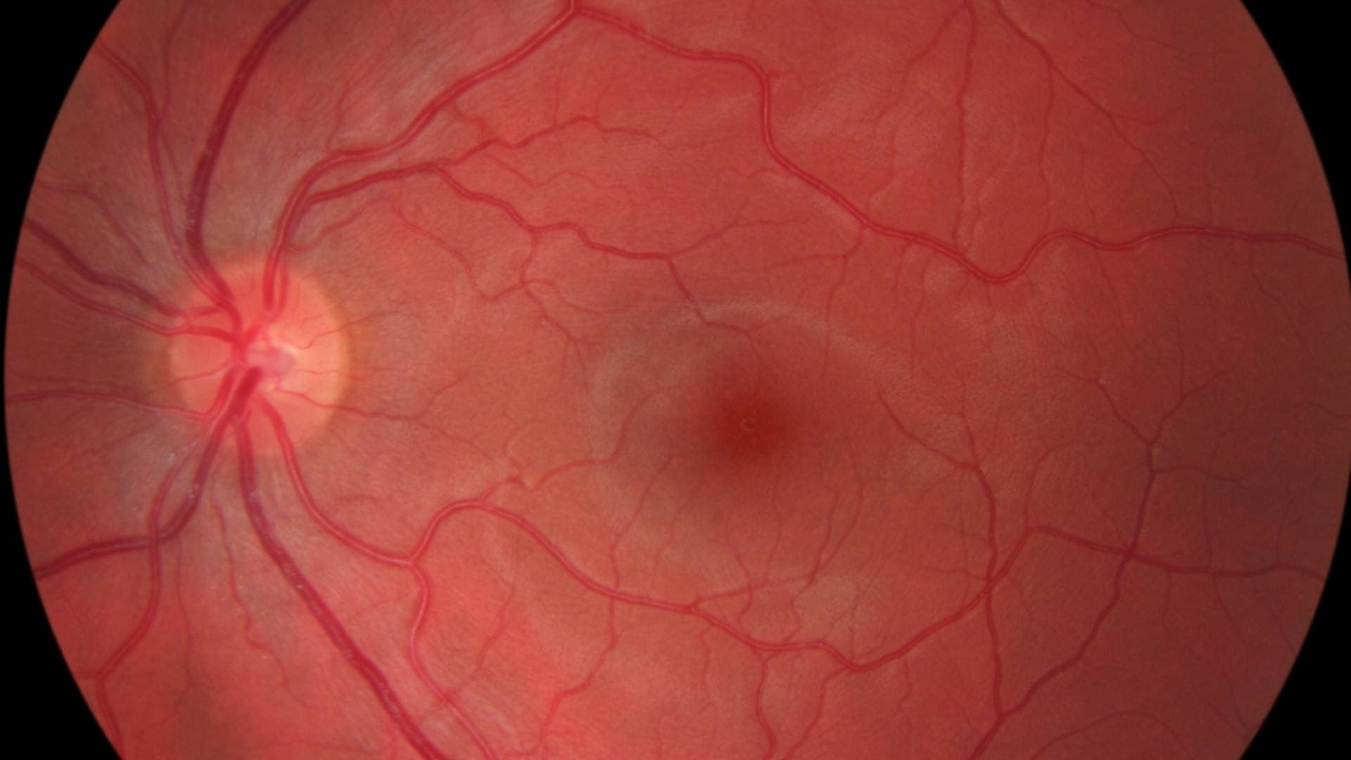 Retina Damar Tıkanıklıkları Tanı, Tedavi ve Görünüm