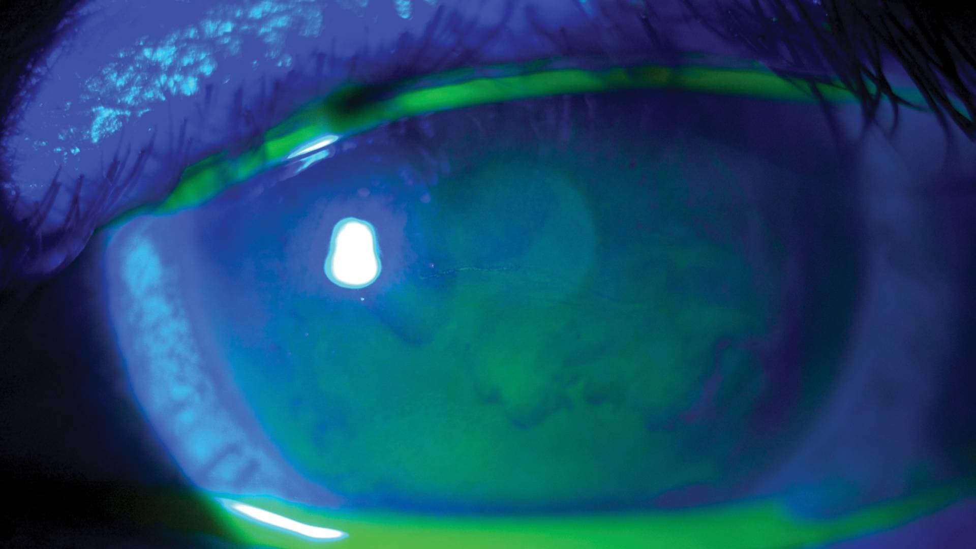 Retina Dekolmanı