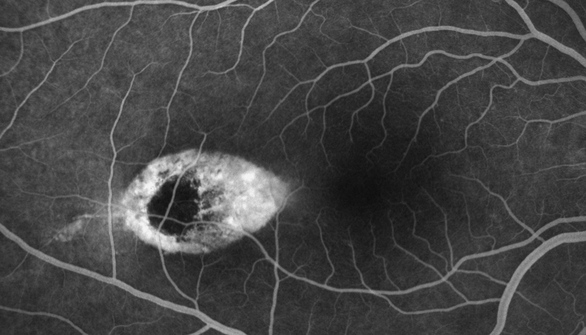 FFA (Fundus Floresein Anjiografisi) Göz Anjiografisi