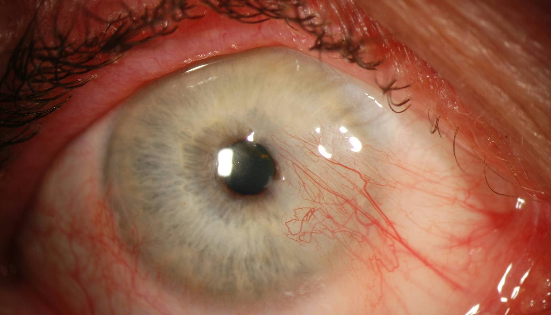 Pterjium - Gözde Et Büyümesi