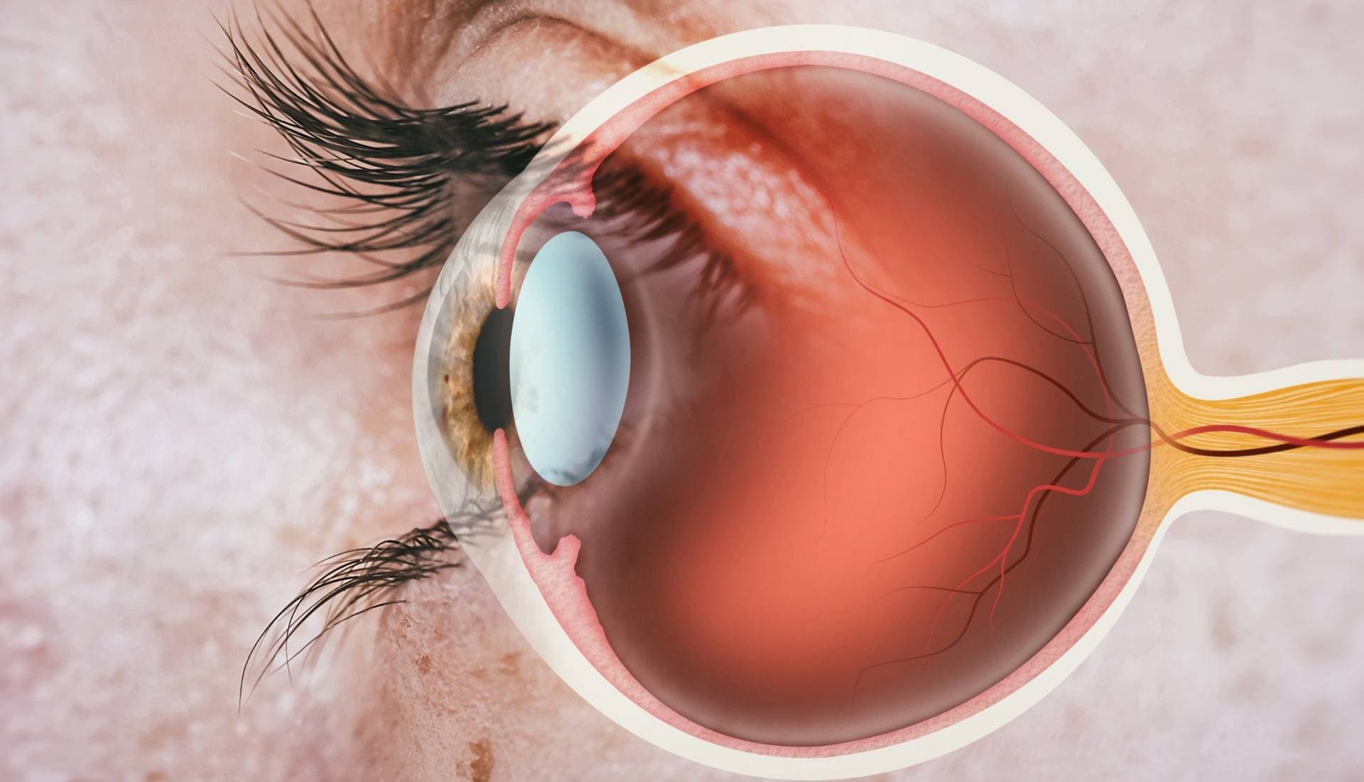Vitrektomi - Retina Cerrahisi