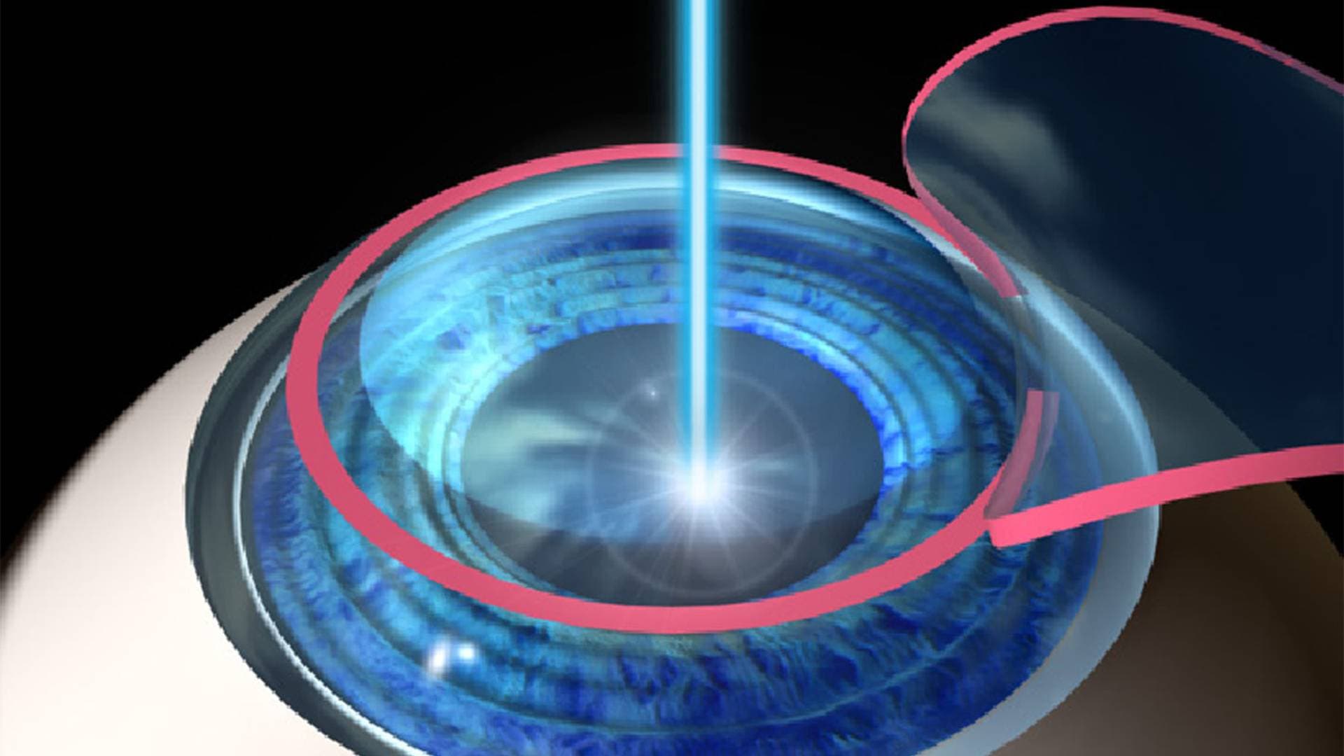 Lasik Lazer Göz Ameliyatı Acıtır Mı?